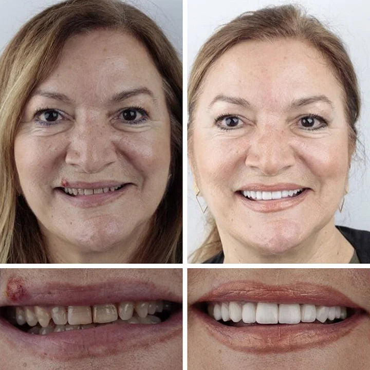 Ends Today: 70% OFF! ⏰70% OFF! EETTSY™ Medical Full Denture with Strong Suctiond Custom-Fit Full Functional Dentures🦷Obtain American Dental Association (ADA) Certification